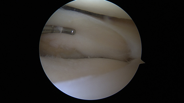 Inatct Lateral Meniscus